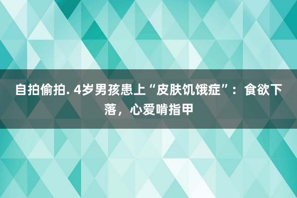 自拍偷拍. 4岁男孩患上“皮肤饥饿症”：食欲下落，心爱啃指甲